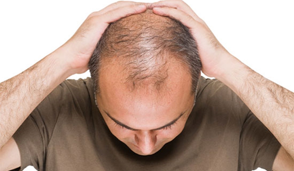 Levantamento revela os 21 países mais carecas do mundo; veja a lista Índice de calvície no país campeão chegou a 42.8%