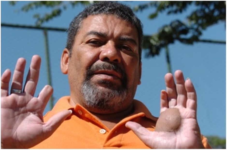 Há mais de três décadas, vítimas do Césio 137 sofrem com descaso e falta de auxílio