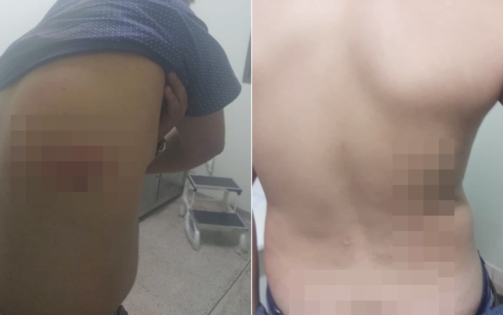 Adolescentes ficaram com lesões nas costas após açoite (Foto: Reprodução / G1)