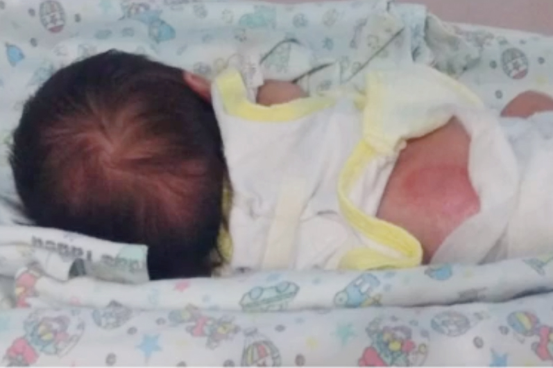 Recém-nascida sofreu queimaduras pelo corpo (Foto: Reprodução)