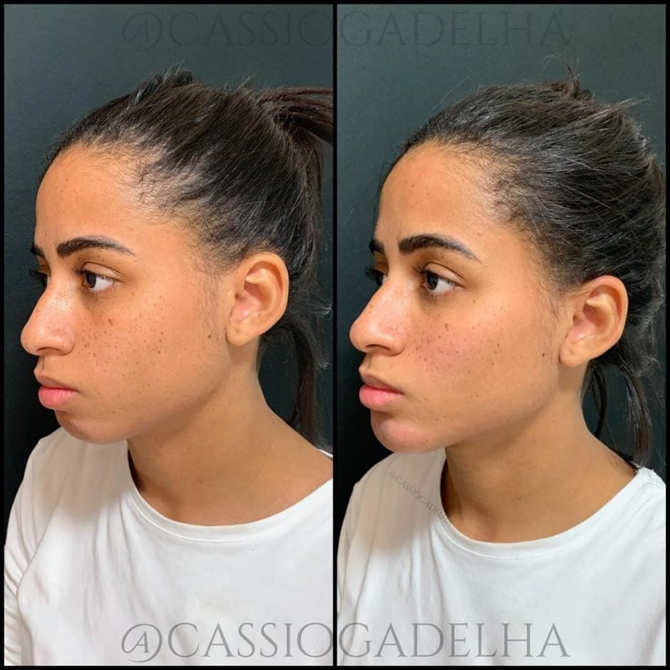 Mc Loma faz harmonização facial