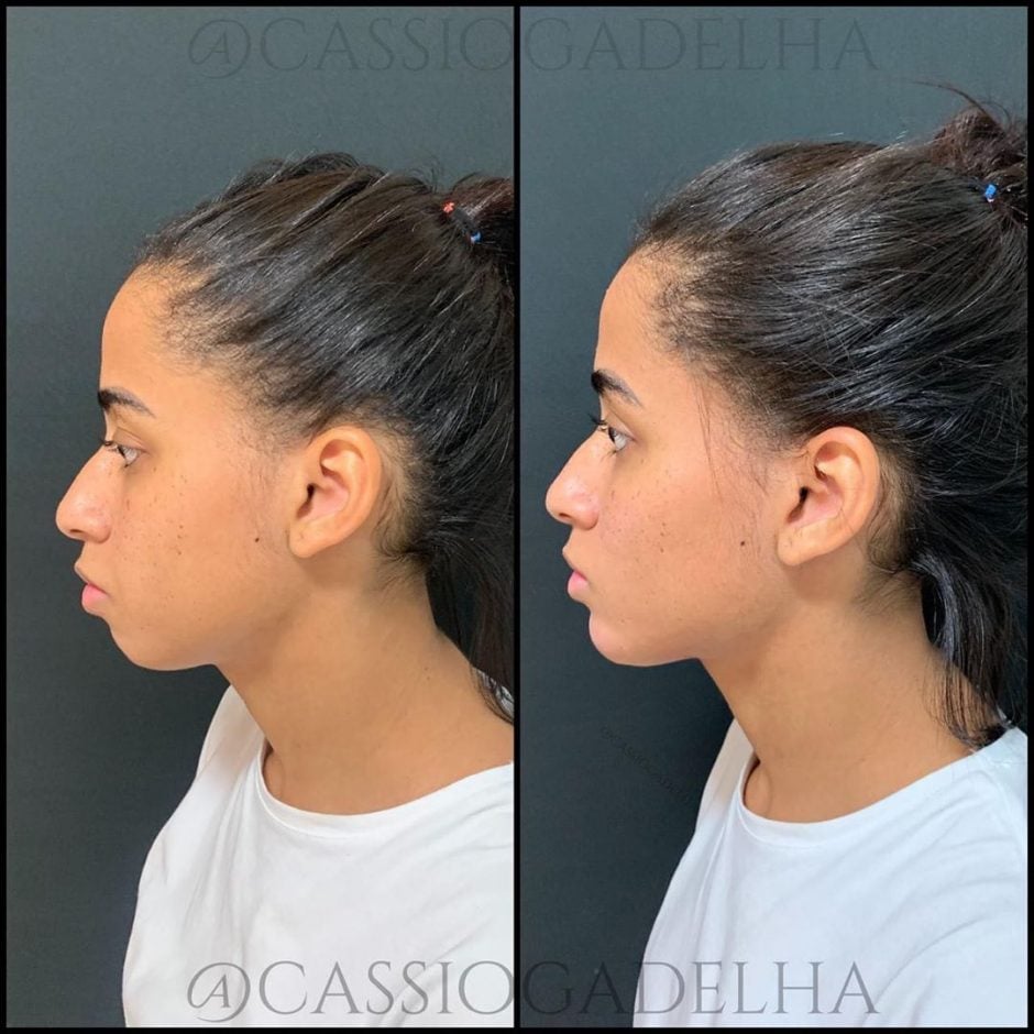 Mc Loma faz harmonização facial