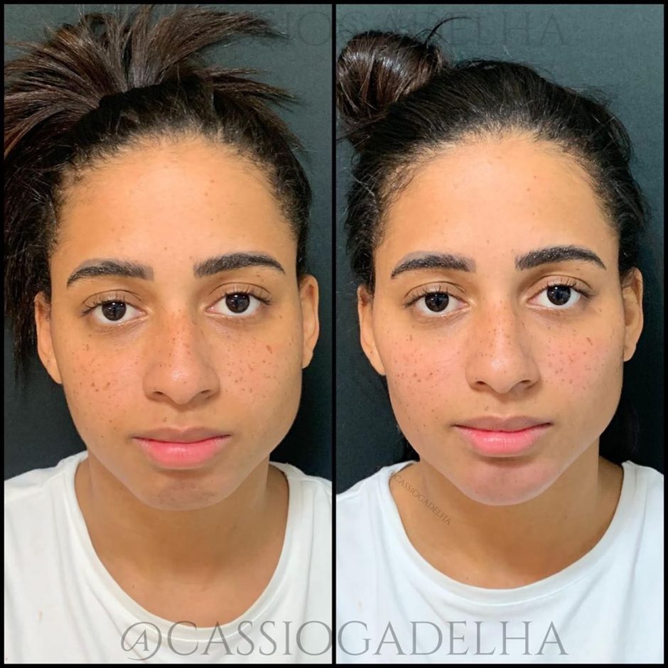 Mc Loma faz harmonização facial