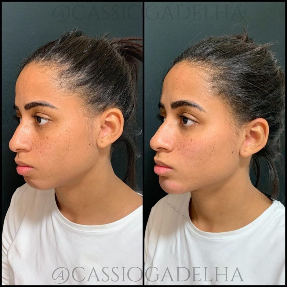 Mc Loma faz harmonização facial