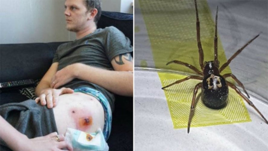 Devido aos ferimentos, o rapaz contou que ficou dois meses sem conseguir andar e tomar banho, já que as dores eram insuportáveis.