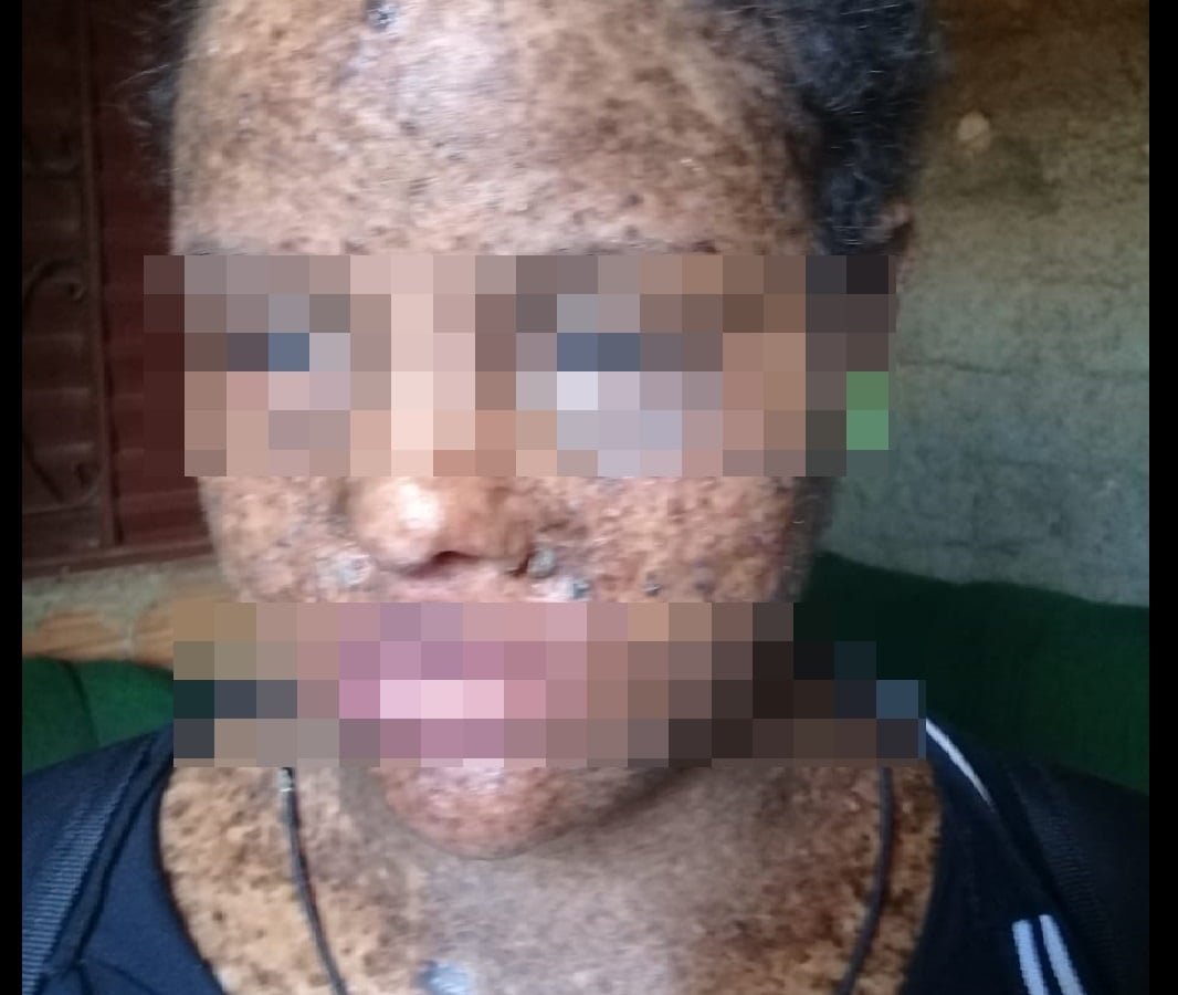 Em Faina, 114 portadores de xeroderma pigmentoso, doença rara, reclamam de descaso