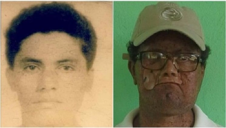 Deíde perdeu parte do rosto por causa da doença Xeroderma Pigmentoso (Foto: Arquivo Pessoal)