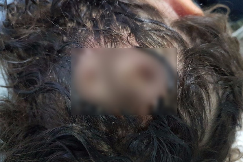 Mais de 40 larvas são retiradas de cabeça de criança