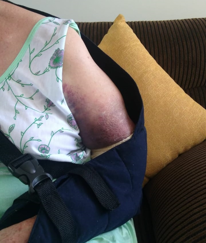 Idosa quebra o braço após ser derrubada em hipermercado em Goiânia