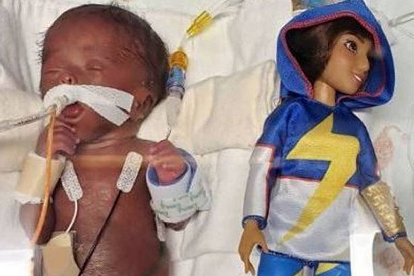 Bebê que nasceu menor que uma boneca Barbie sobrevive e chega aos 7 kg
