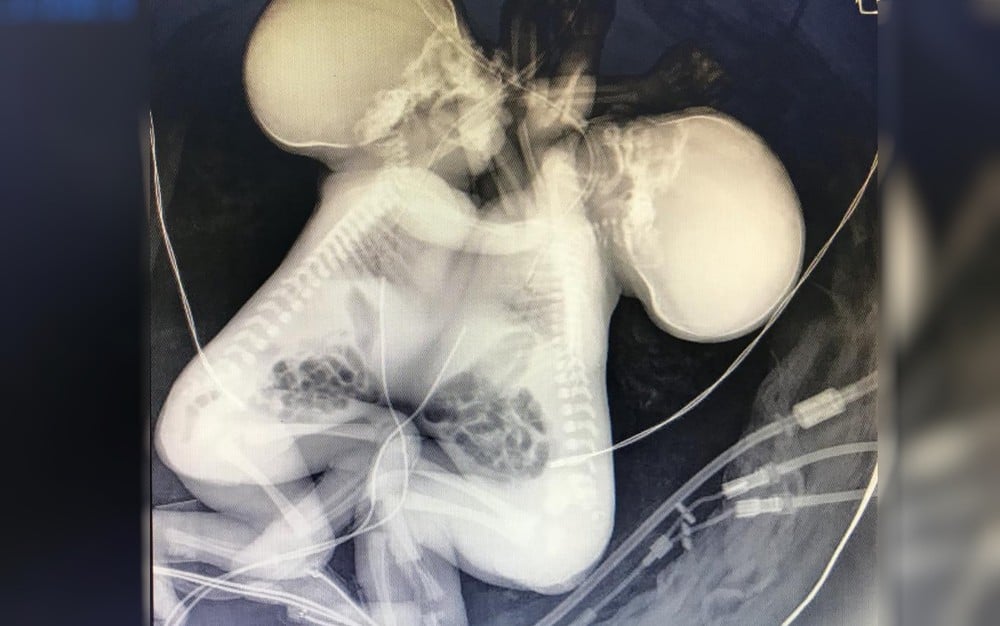 Gêmeas siamesas que compartilhavam o coração morrem no Materno Infantil, em Goiânia