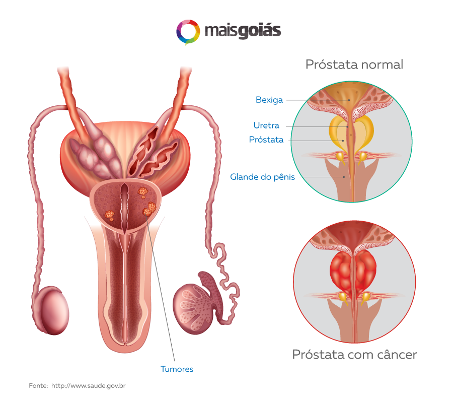 Câncer de próstata