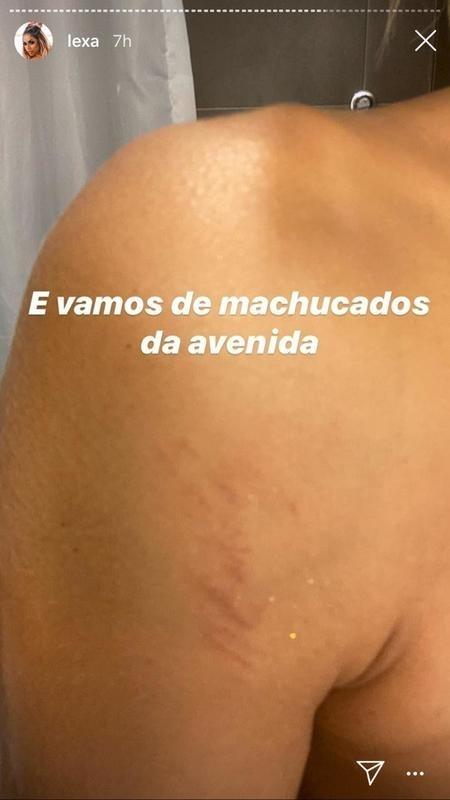 Lexa mostra machucados após tombo na Sapucaí