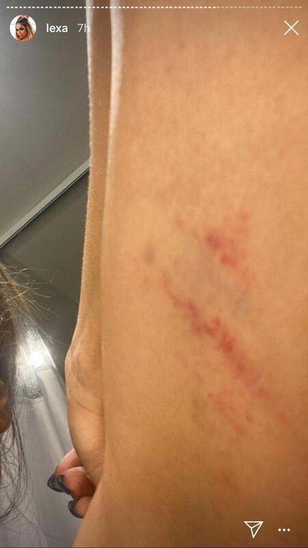 Lexa mostra machucados após tombo na Sapucaí