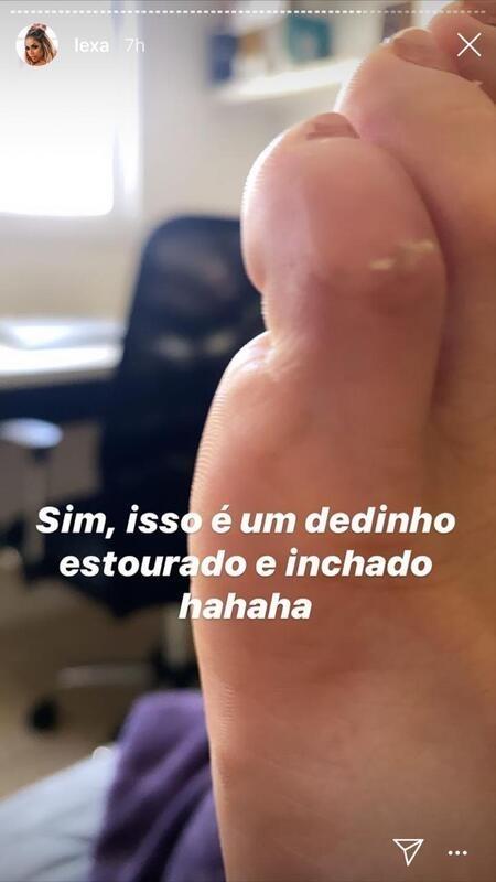 Lexa mostra machucados após tombo na Sapucaí