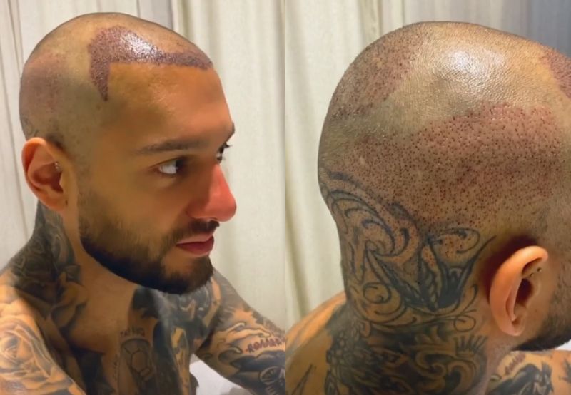 Lucas Lucco aparece careca e revela que fez implante capilar