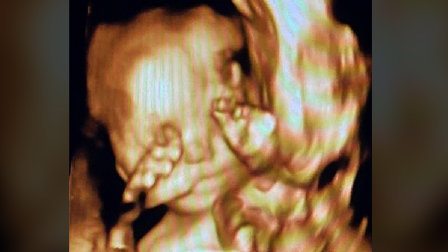 O deputado federal Eduardo Bolsonaro (PSL-SP) postou uma foto hoje do ultrassom da sua primeira filha, Geórgia, e brincou que ela está tentando fazer o "sinal de arminha". (Foto: reprodução)