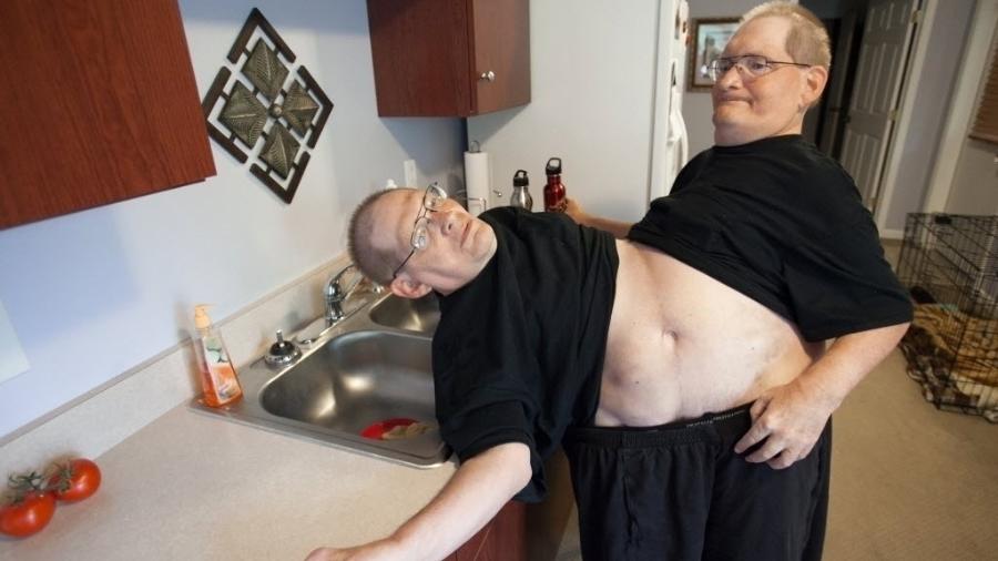 Os irmãos Ronnie e Donnie Galyon, gêmeos siameses mais velhos do mundo, morreram na cidade de Dayton, no estado de Ohio, nos Estados Unidos. (Foto: The Daily News, Drew Simon/AP)