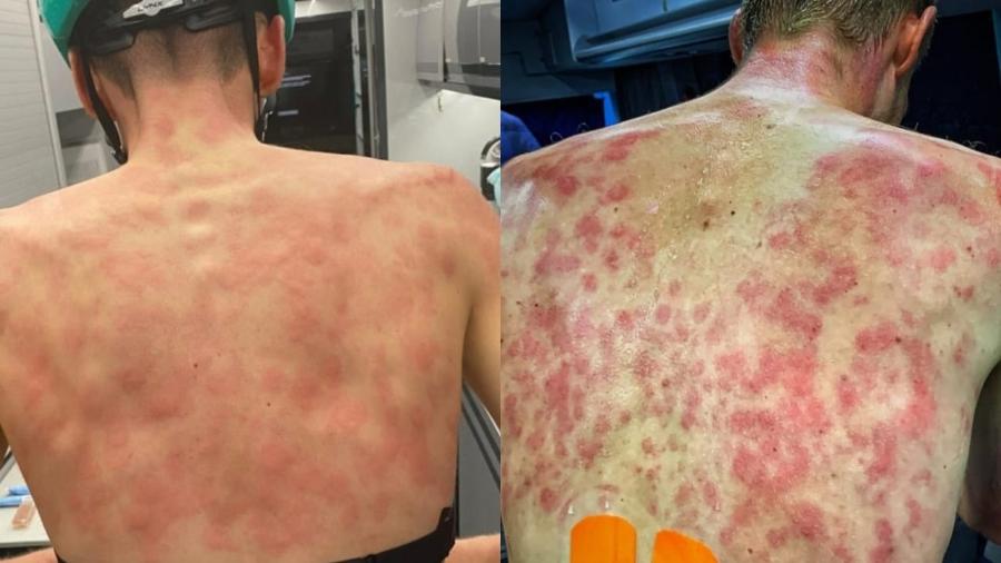 Uma chuva de granizo deixou diversas marcas nas costas de ciclistas em uma competição na França. (Foto: reprodução)