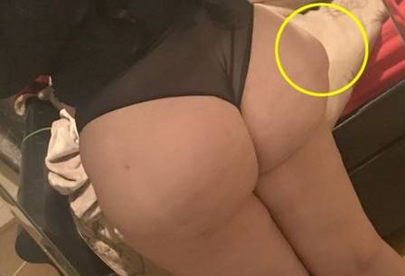 Bumbum de jovem fica com "cones" após três cirurgias