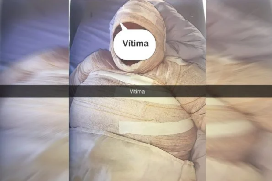 Mulher que ateou fogo em companheira é presa após vítima acordar do coma, no DF