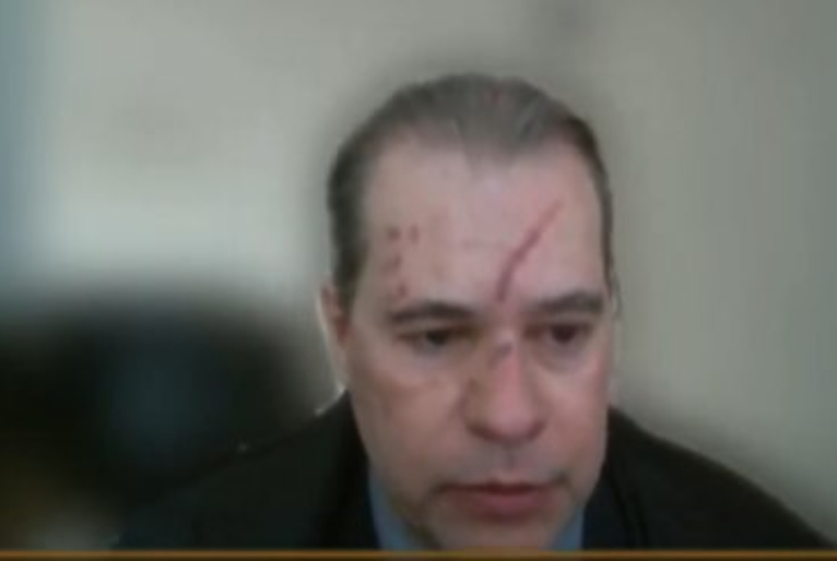 Em sessão do STF, ministro Dias Toffoli aparece com hematomas no rosto