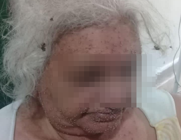 Situação da idosa após as diversas ferroadas que sofreu do ataque (Foto: divulgação/PM)