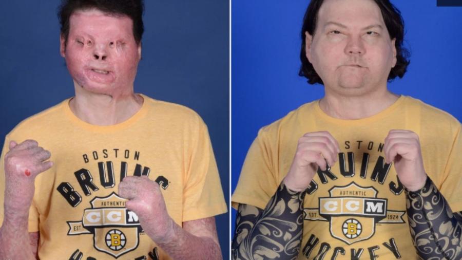 Joe DiMeo Vítima de acidente de carro recebe primeiro transplante de rosto e de mãos