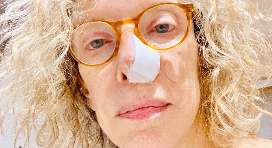 Marília Gabriela revela ter feito cirurgia para retirar câncer de pele do nariz