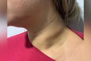 Preso suspeito de esfaquear pescoço da ex-companheira, em Piracanjuba