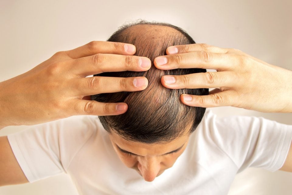 Alterações para combater a doença causam fios fracos e quebradiços, diz especialista. Queda de cabelo pós covid é comum; entenda o porquê