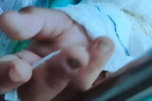 Menina de 2 anos foi levada a um hospital de Goiânia sem duas unhas e com ferimentos pelo corpo, inclusive, no intestino