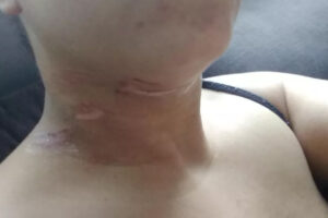 Motociclista corta pescoço após passar por fio de energia solto, em Palmeiras de Goiás