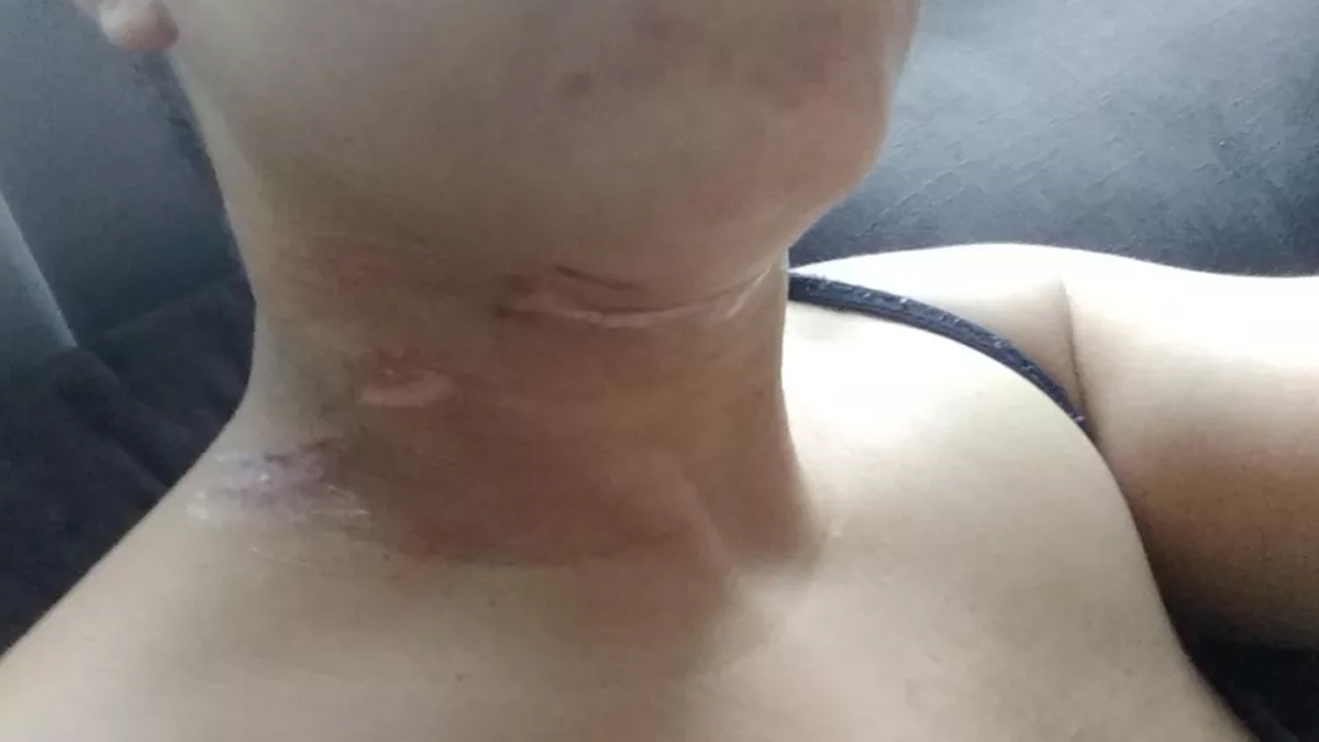 Motociclista corta pescoço após passar por fio de energia solto, em Palmeiras de Goiás