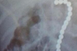 Menino de 2 anos é hospitalizado após engolir 16 esferas magnéticas