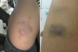 Hematomas na perna da jovem agredida (Foto: Reprodução/TvAnhanguera)