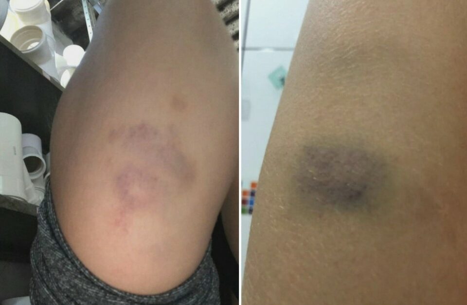 Hematomas na perna da jovem agredida (Foto: Reprodução/TvAnhanguera)