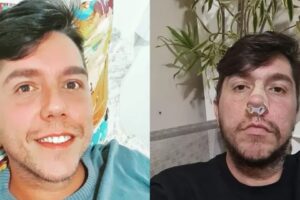 Homem perde parte do nariz após preenchimento labial no RJ