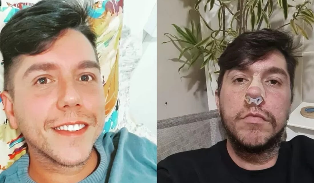 Homem perde parte do nariz após preenchimento labial no RJ