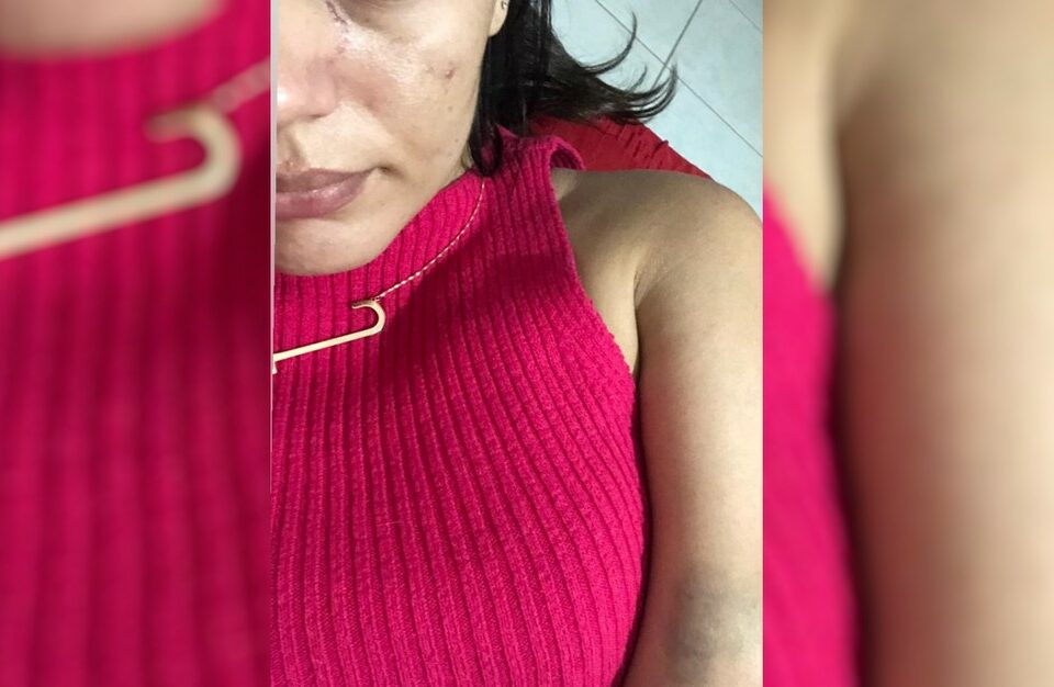hematomas de Jéssika Camargo (Foto: Arquivo pessoal)
