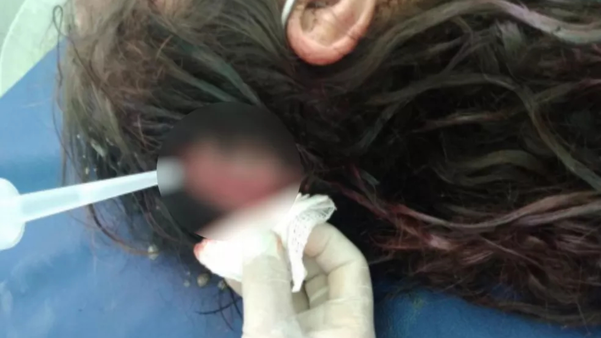 A imagem mostra um corte que a vítima teve na cabeça sendo cuidado por um atendente médico. Foto ilustra: Escondido em caverna, suspeito de espancar mulher por 4 horas é preso em Formosa