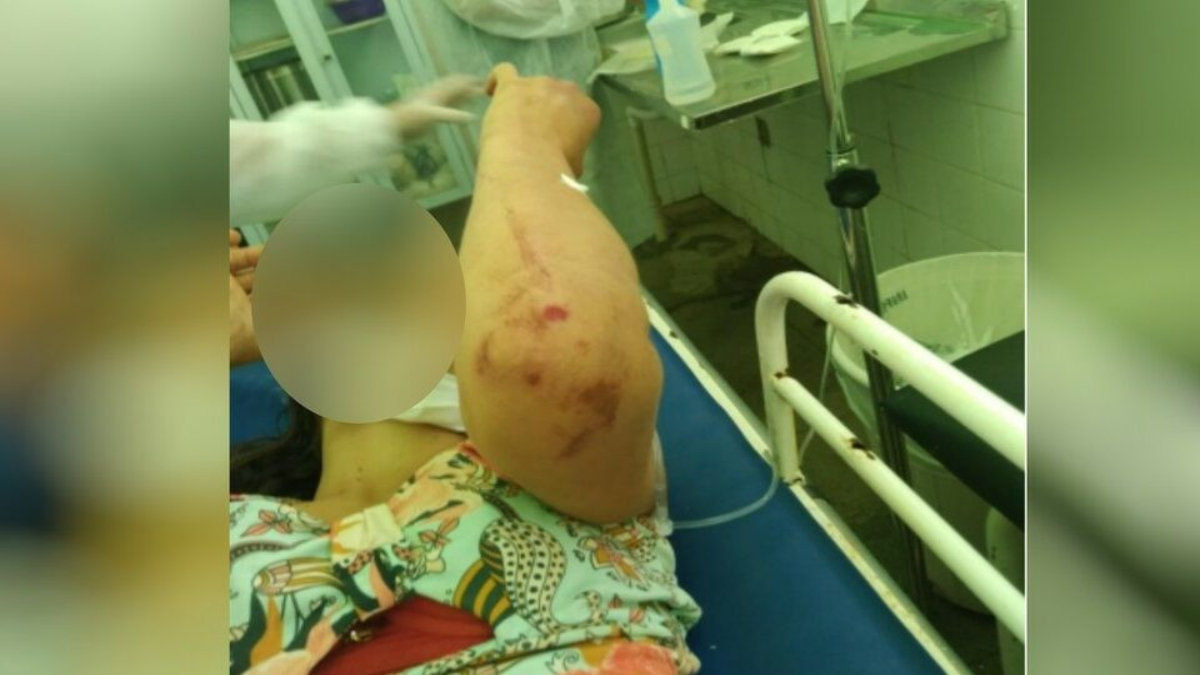 Foto mostra mulher em maca do hospital toda ensanguentada. Ela mostra o cotovelo cheio de sangue.Escondido em caverna, suspeito de espancar mulher por 4 horas é preso em Formosa