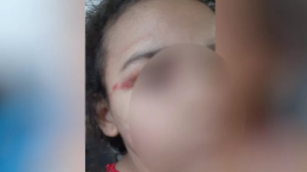 Menina com rosto borrado tem hematoma no rosto. Foto ilustra chamada: Padrasto é suspeito de agredir menina de 6 anos após ficar bêbado em Goiânia