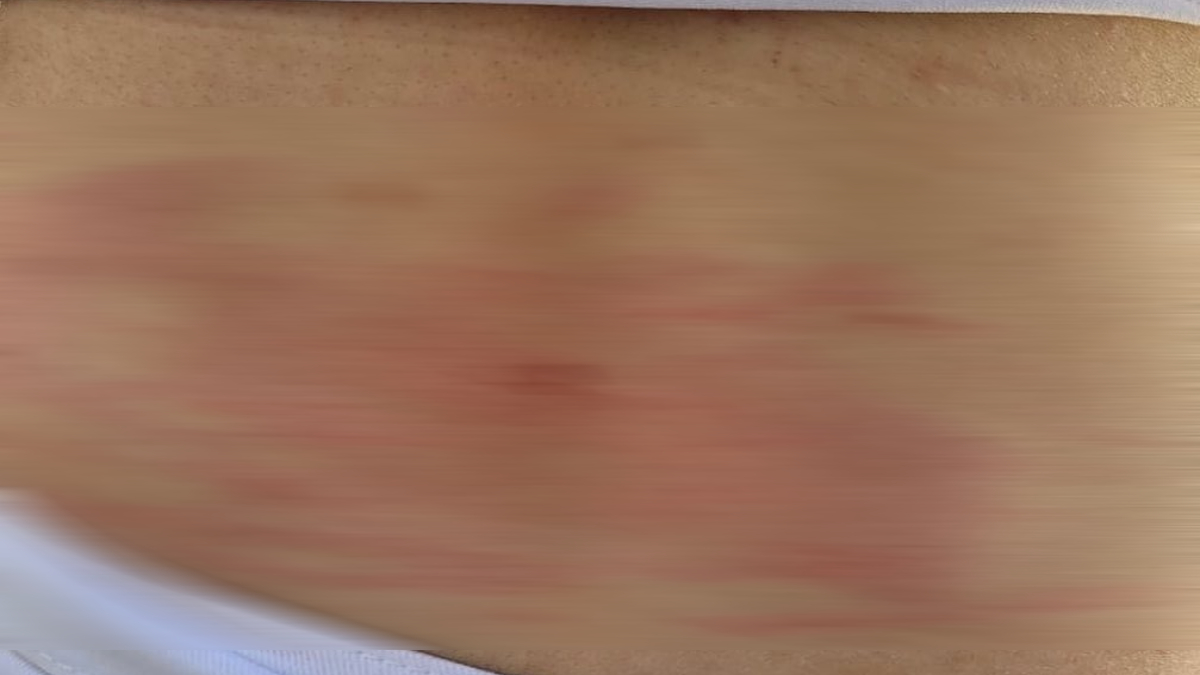 Foto mostra as costas da menina, na região lombar, cheia de escoriações. Pai é suspeito de agredir filha por ela passar mais tempo com a mãe, em Pirenópolis