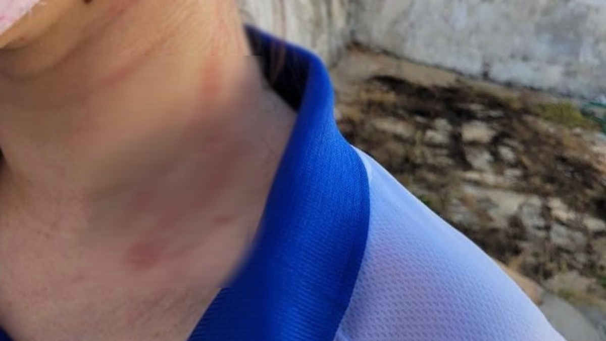 Foto mostra vítima com escoriações no pescoço. Ela usa uma camiseta do brasil, nas cores brancas e detalhes azuis. Pai é suspeito de agredir filha por ela passar mais tempo com a mãe, em Pirenópolis