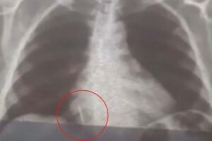 broca pulmão aspirado