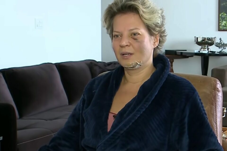 Joice Hasselman aparece com hematomas - PCDF concluiu que ela se feriu ao cair da própria altura