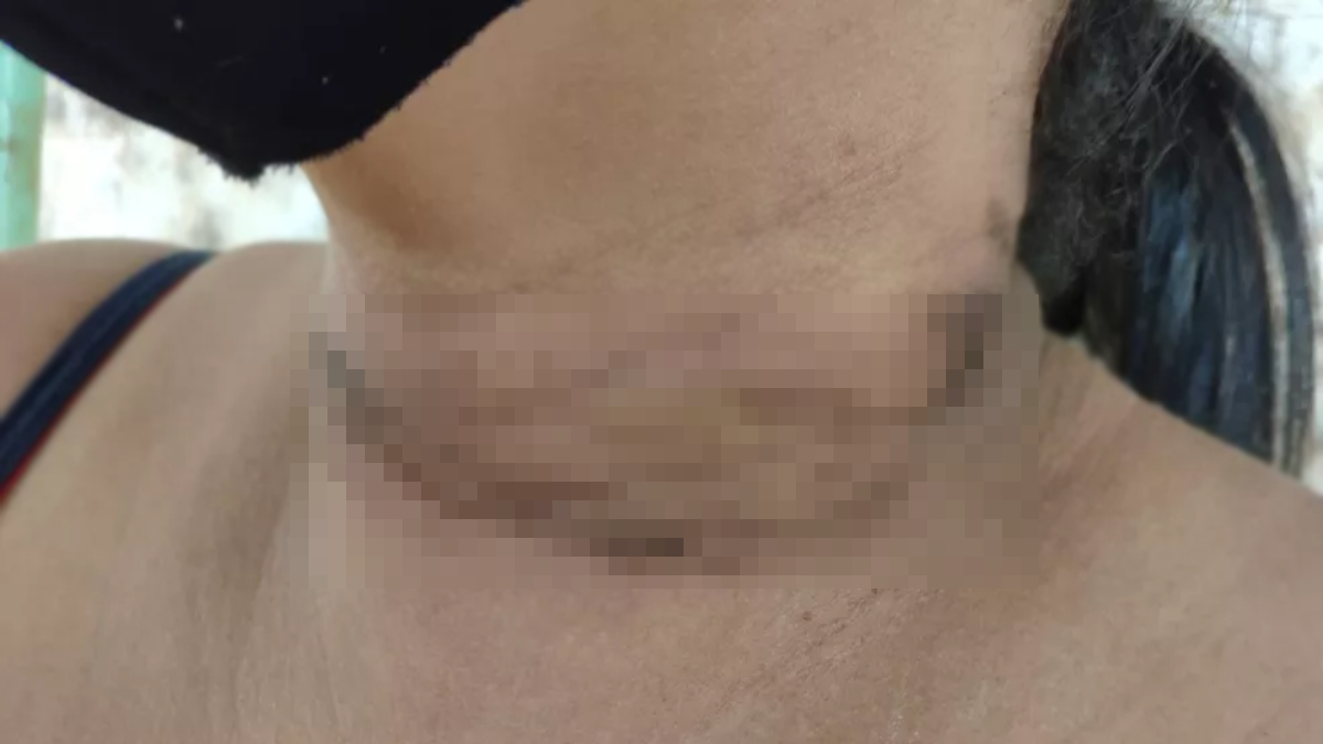 Foto mostra queimaduras em todo o entorno do pescoço da mulher. Foto ilustra: Motociclista fica ferida após ser atingida por fio de internet solto em Jataí