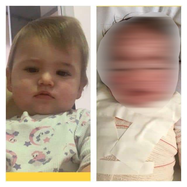 Reação alérgica deixa criança de Anápolis com rosto desfigurado