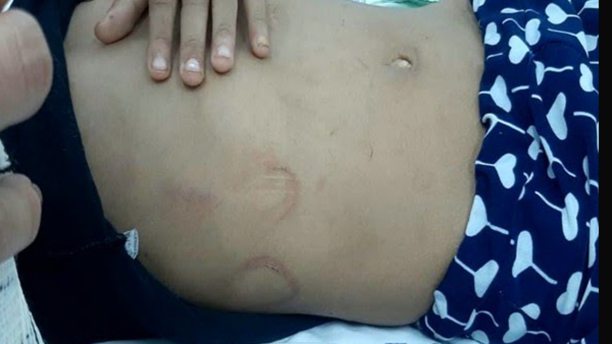 Hematomas na barriga da criança agredida pelo pai e madastra em Aparecida de Goiânia